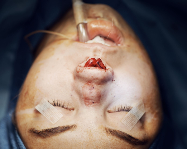rhinoplasty nose photos for allure.com's life in plastic column