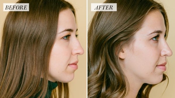 rhinoplasty before and photos for allure.com's life in plastic column